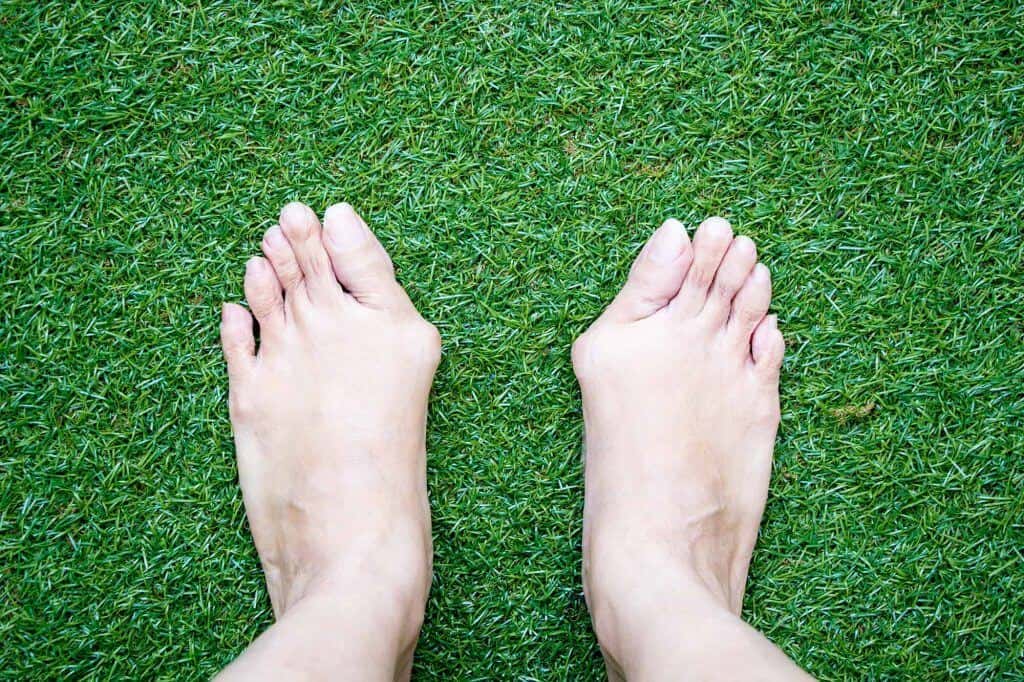Bunion