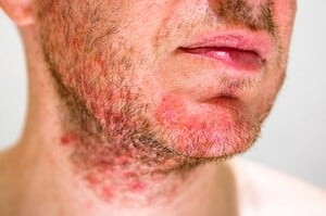 Keradangan folikel rambut dalam kulit 'Folikulitis' (Folliculitis) - Jenis, Punca, Simptom, Diagnosis, Faktor Risiko dan Rawatan