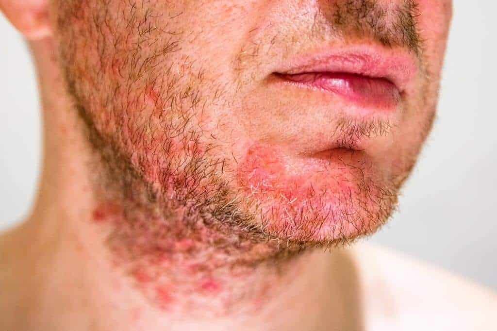 Folikulitis