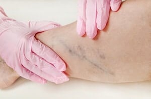 Trombosis Vena Dalam (Deep vein thrombosis) - Punca, Simptom, Diagnosis, Faktor Risiko, Komplikasi dan Rawatan