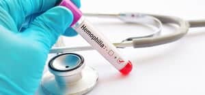 Hemofilia B (Hemophilia B) - Punca, Simptom, Diagnosis dan Rawatan