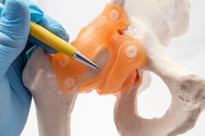 Displasia Pinggul (Hip Dysplasia) - Punca, Simptom, Diagnosis dan Rawatan