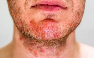 Dermatitis Seborrheic (Seborrheic dermatitis) - Simptom, Punca, Diagnosis, Faktor Risiko dan Rawatan