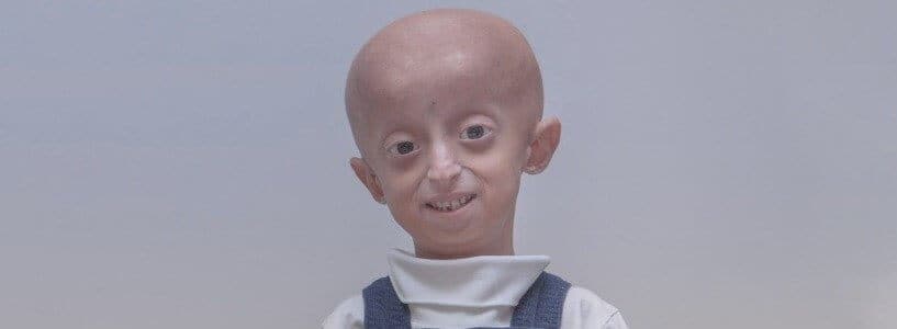 Progeria