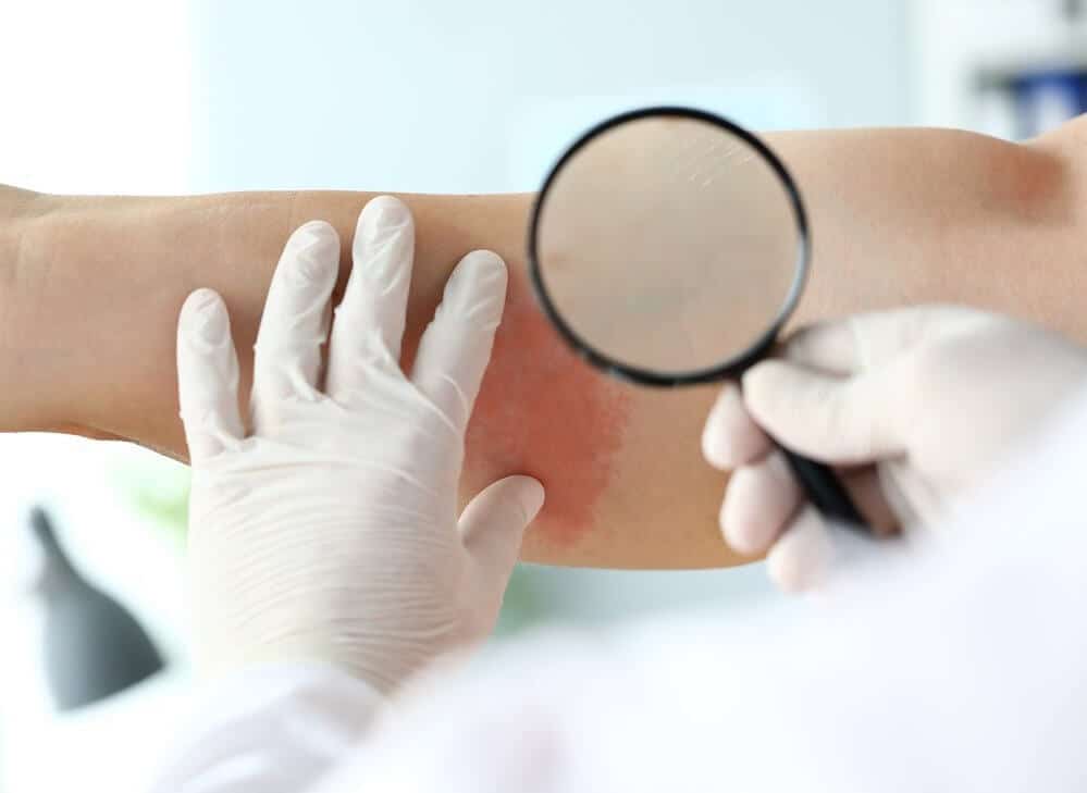 skleroderma terhad