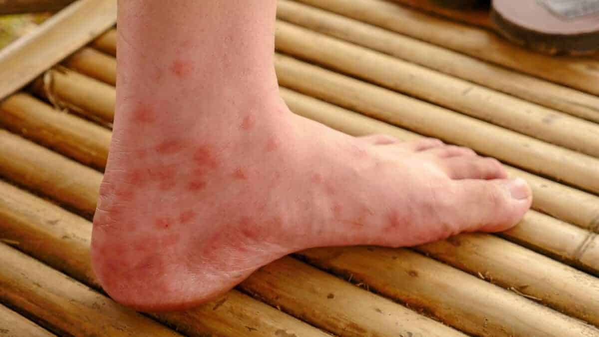 gangrenosum pyoderma