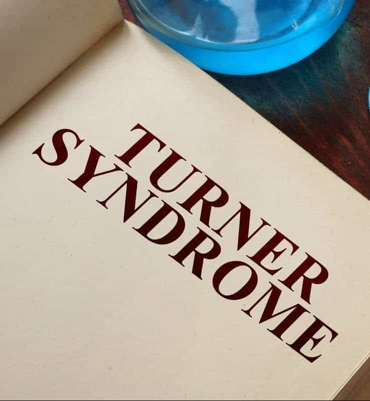 sindrom turner