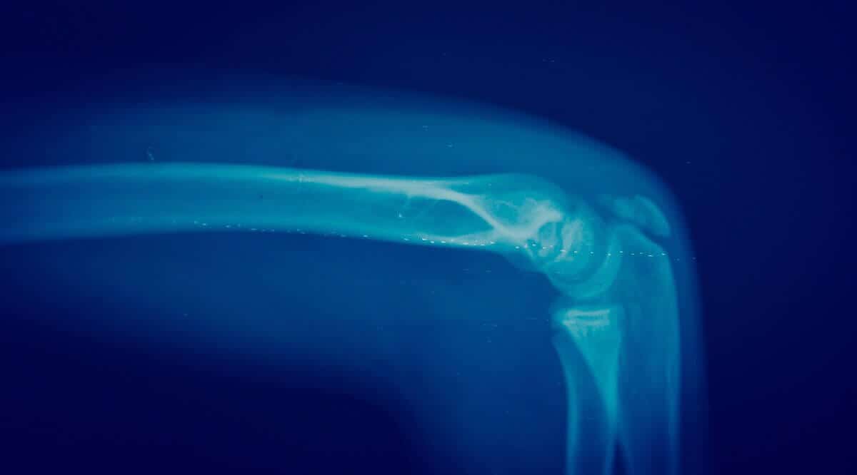 kanser tulang sarcoma
