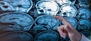 Kanser otak sekunder (Secondary brain cancer) - Simptom, Punca, Diagnosis, Faktor Risiko dan Rawatan