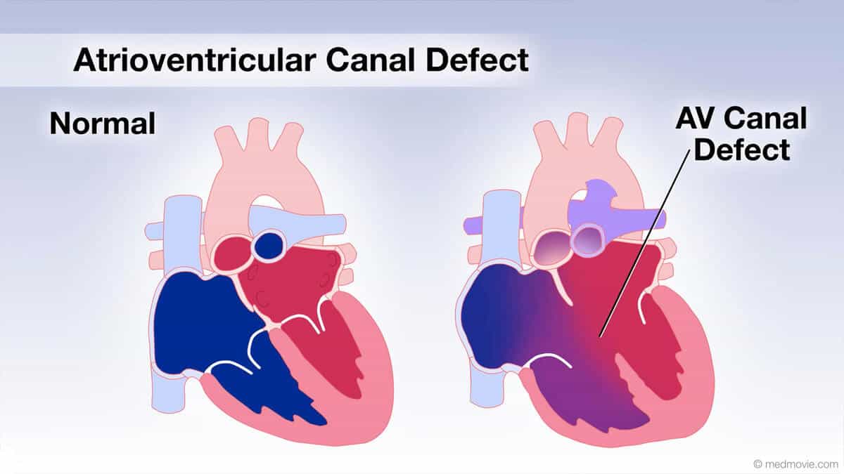 kecacatan septum atrioventrikular