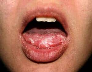 Lapisan Putih Pada Lidah (White Layer On Tongue)