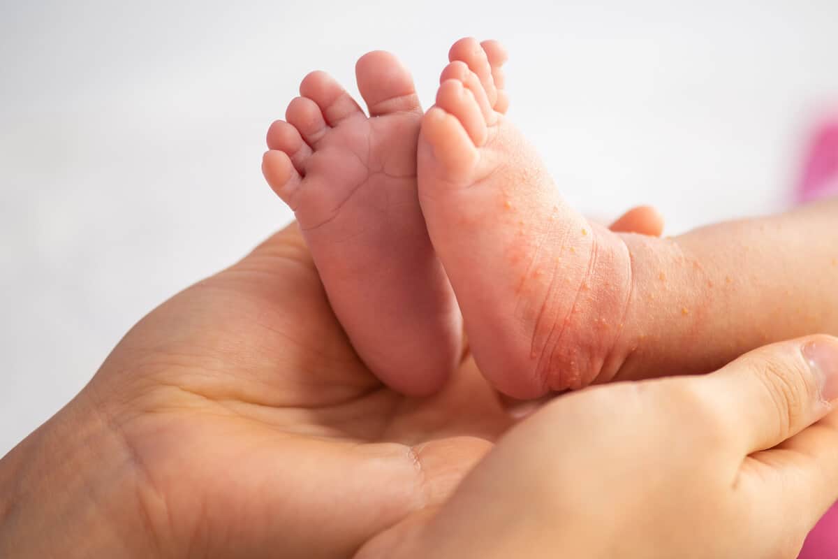 roseola