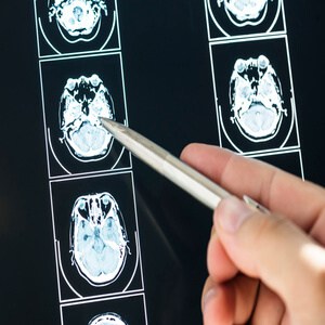 Schwannoma - Simptom, Punca, Diagnosis dan Rawatan