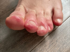 ‘COVID Toes’: Simptom Luar Biasa Pesakit Coronavirus