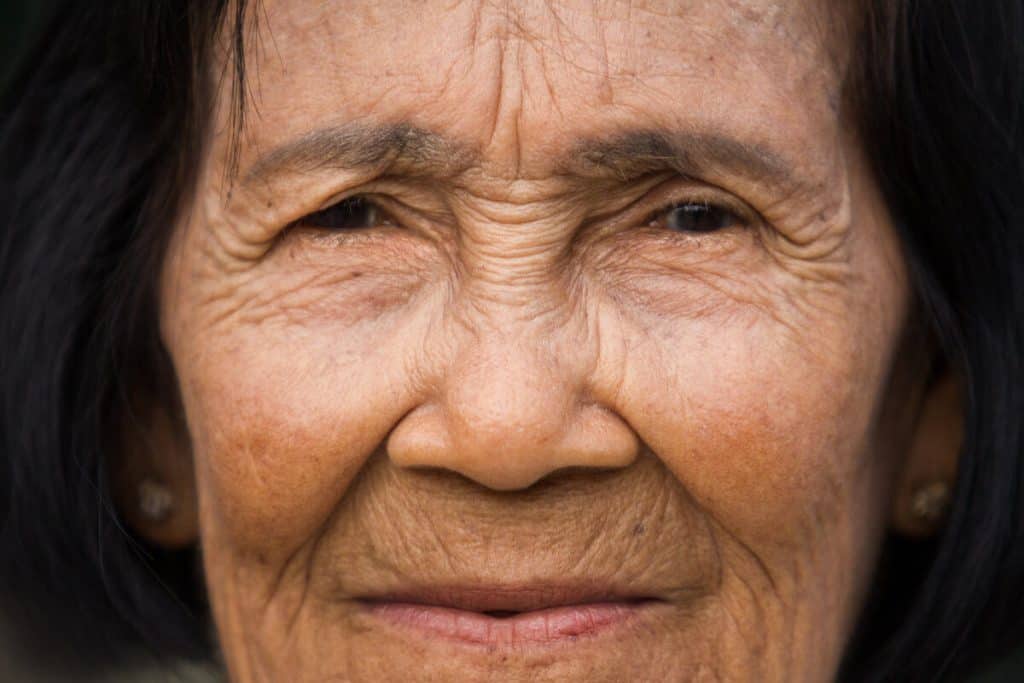 Kedutan (Wrinkles) - Simptom, Punca dan Rawatan - Ceriasihat