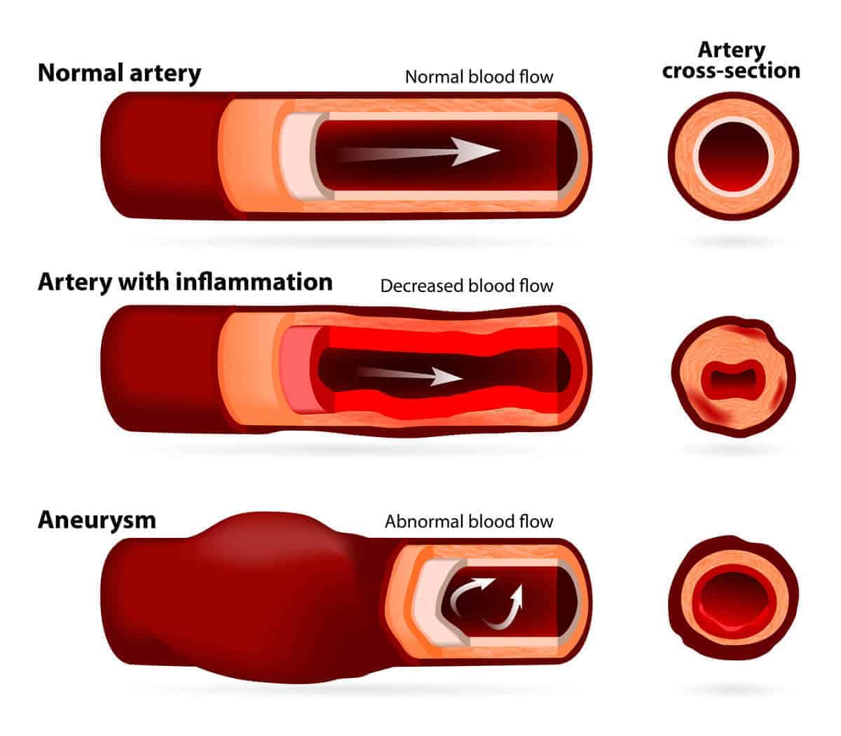 Aneurisme Arteri Popliteal