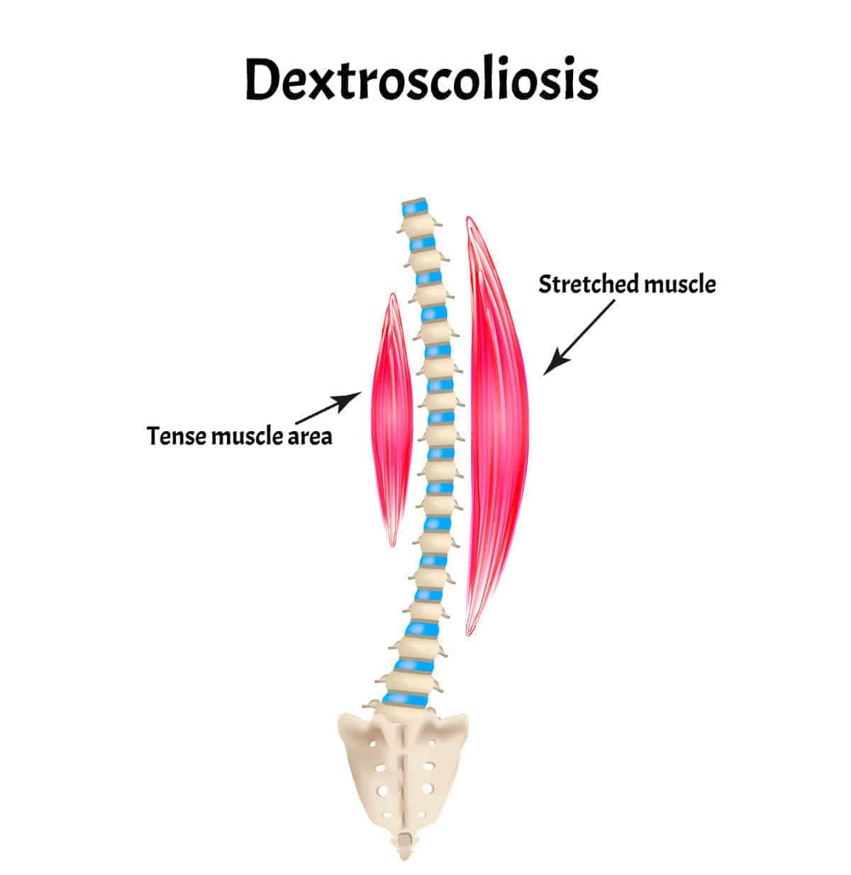 Dextroscoliosis