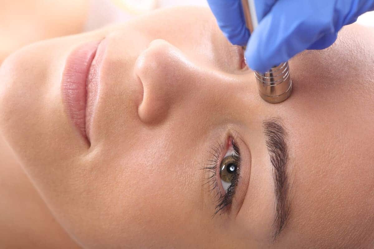 microdermabrasion