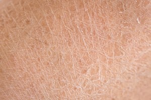 Xerosis ( Kulit Kering ) – Punca, Simptom, Diagnosis dan Rawatan