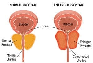 Hiperplasia prostat (Benign Prostate Hyperplasia - BPH) - Simptom, Punca, Diagnosis, Faktor Risiko dan Rawatan