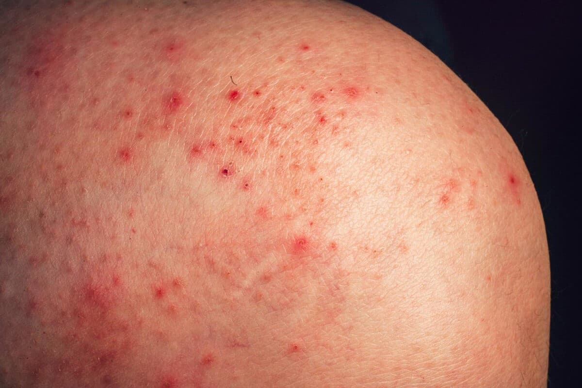 petechiae