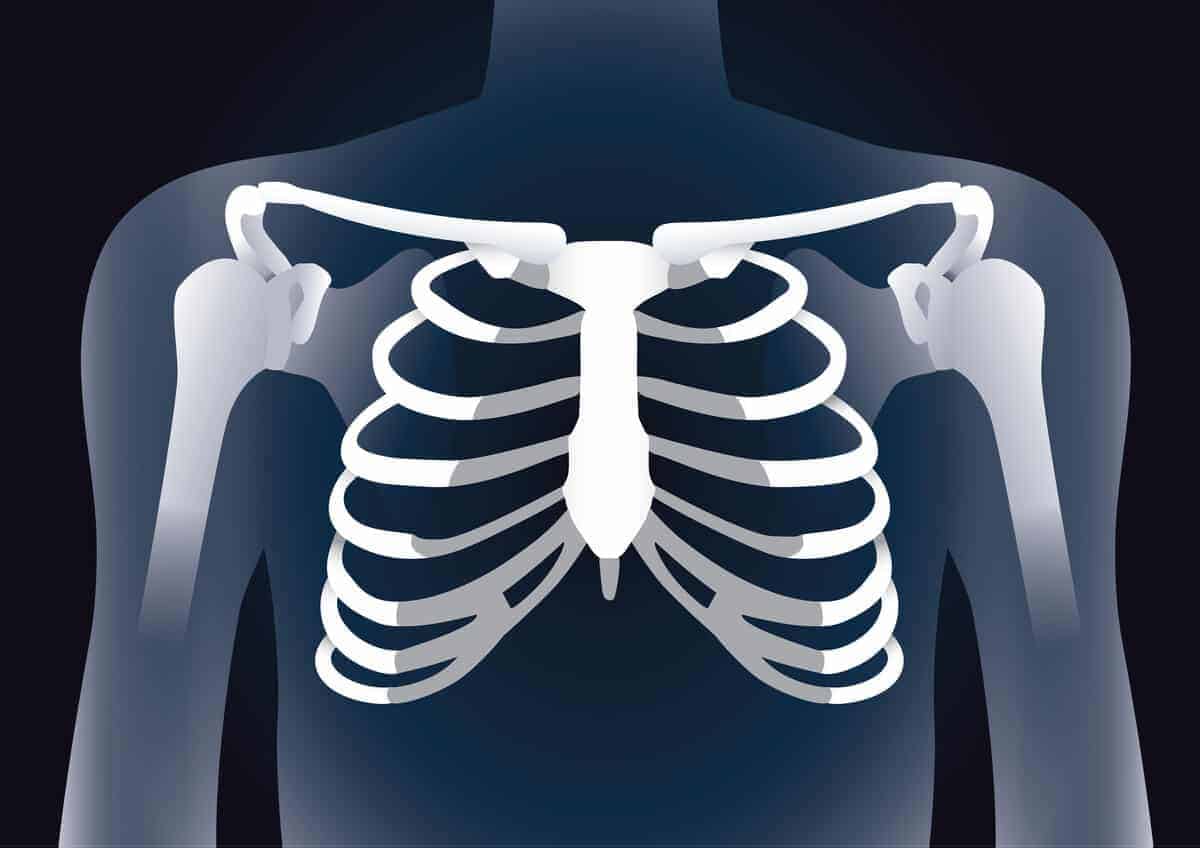 Costochondritis