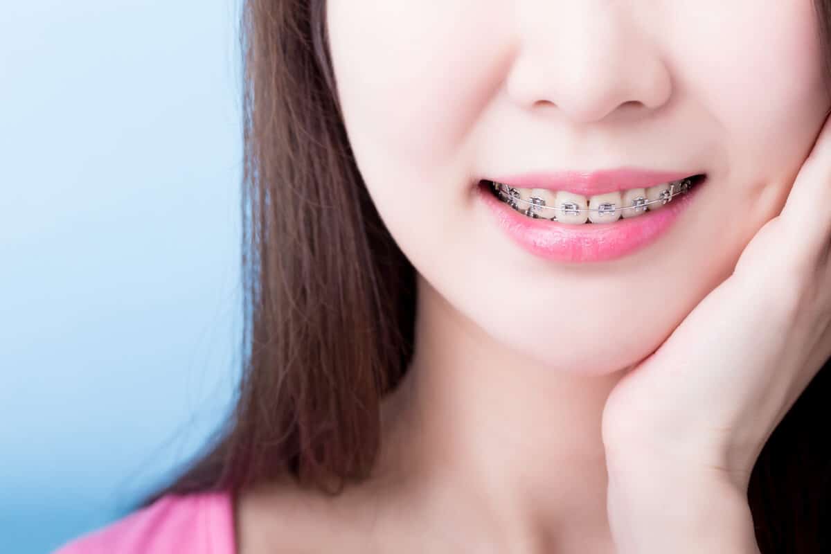 fake braces