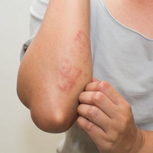 Alergi Kulit: Punca, Simptom Serta Rawatan