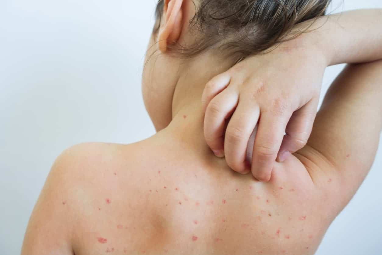 Vaksin Chickenpox - Info Penting yang Anda Perlu Tahu